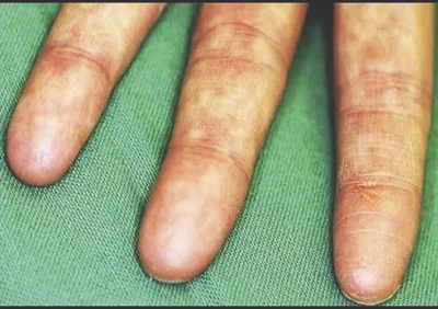 Teenage girl’s UTME registration fails over missing fingerprints, highlights biometric exclusion